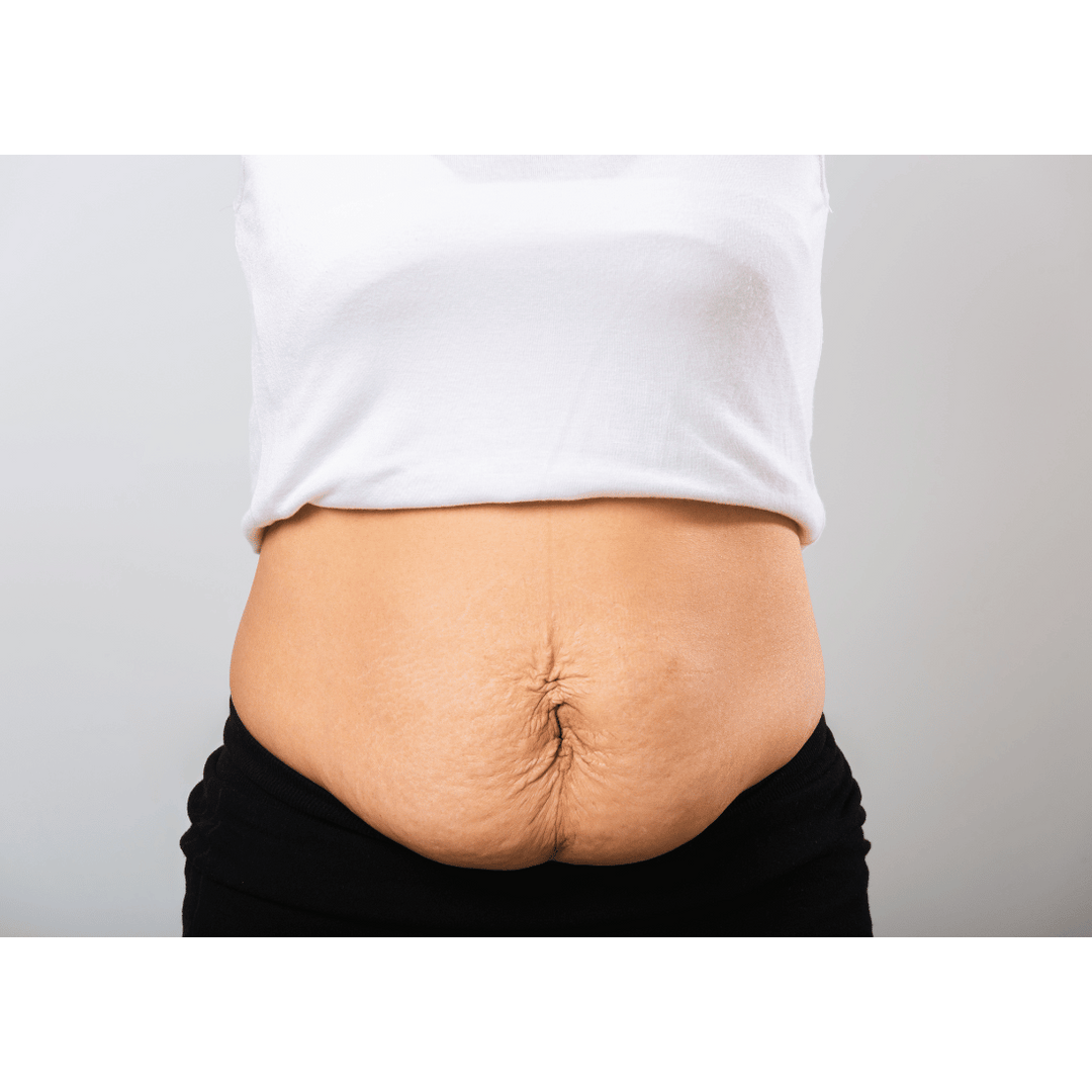 How to Tighten Loose Skin on Stomach Without Surgery BON CHARGE Bon